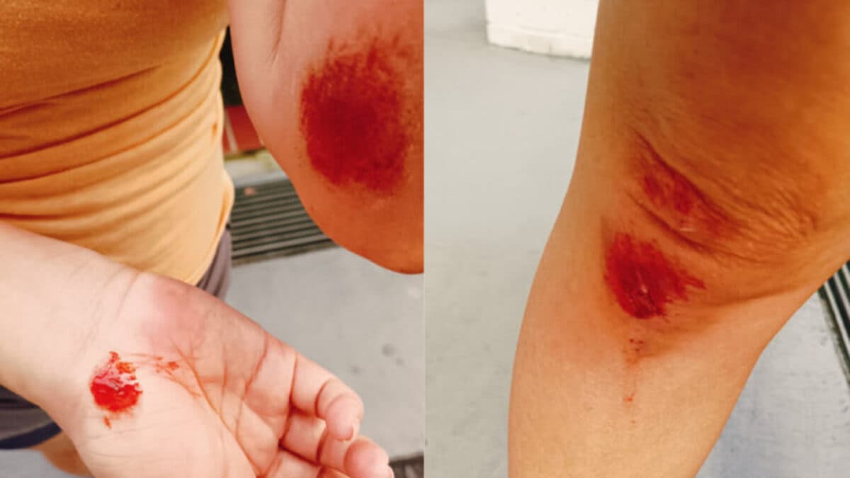 Woman injured by PMD at Pasir Ris.jpg